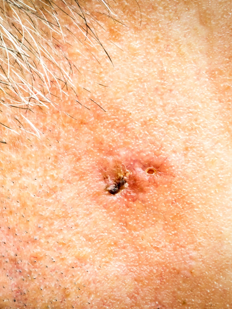 Basal Cell Carcinoma Skin Clinic Taranaki